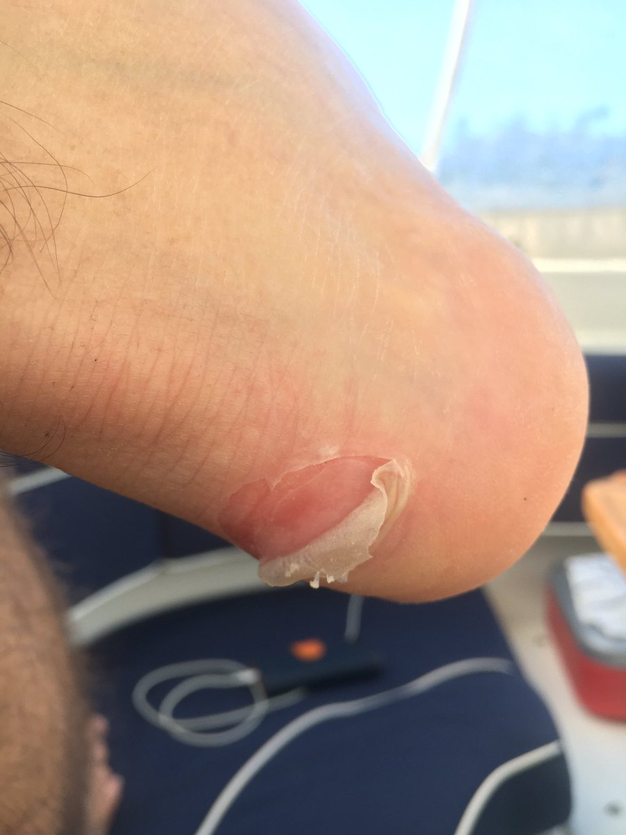 Alla skavsårs moder