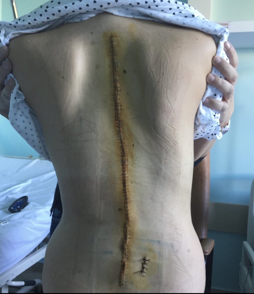 Feerrnweh's tweet photo. Vi chiedo per favore di rt il più possibile e, se volete e potete, di donare qualcosa.

https://t.co/d3tRAcLYBI

Dopo tanti interventi vorrei provare ad avere una vita normale da diciannovenne e tornare a scuola, ma solo una privata verrebbe incontro ai miei problemi di salute. https://t.co/ZN671BoxQz