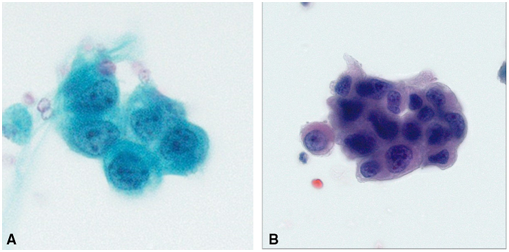 CancerCytopath's tweet photo. New! The difference in ROM between "Suspicious for high grade urothelial carcinoma" & "High grade urothelial carcinoma" was statistically significant in this study's cohort. The authors suggest that the 2 categories remain separate in #TheParisSystem. https://t.co/UJnN4MA79e https://t.co/eQefuU8cjI