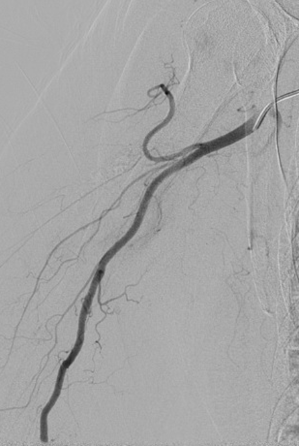 Weill Cornell Medicine Interventional Radiology (@weillcornell_ir) on Twitter photo Collaboration between specialties is essential for patient care. #irad helping our #Orthopedics colleagues with a pre-op embo prior to fixation. RCC met to the humerus with associated fracture. Some spheres and gelfoam does the trick! #twittir <a href="/SIRRFS/">SIR RFS</a> <a href="/SIR_ECS/">SIR ECS</a> <a href="/SIRspecialists/">Society of Interventional Radiology</a> Collaboration between specialties is essential for patient care. #irad helping our #Orthopedics colleagues with a pre-op embo prior to fixation. RCC met to the humerus with associated fracture. Some spheres and gelfoam does the trick! #twittir <a href="/SIRRFS/">SIR RFS</a> <a href="/SIR_ECS/">SIR ECS</a> <a href="/SIRspecialists/">Society of Interventional Radiology</a>