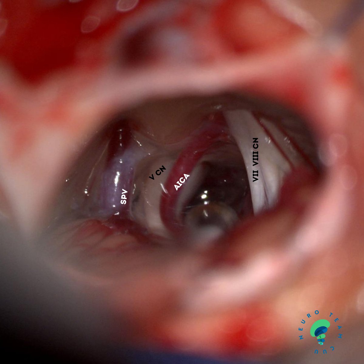 ordomd's tweet image. Microvascular decompression for trigeminal neuralgia through retrosigmoid approach

@DrArturoMCobos @Ostorfi @luisalane9 @Jose_Carlossss 

#trigeminal #neuralgia #pain #facialpain #neuroteamcuu #neurosurgery #microsurgery #medicine
