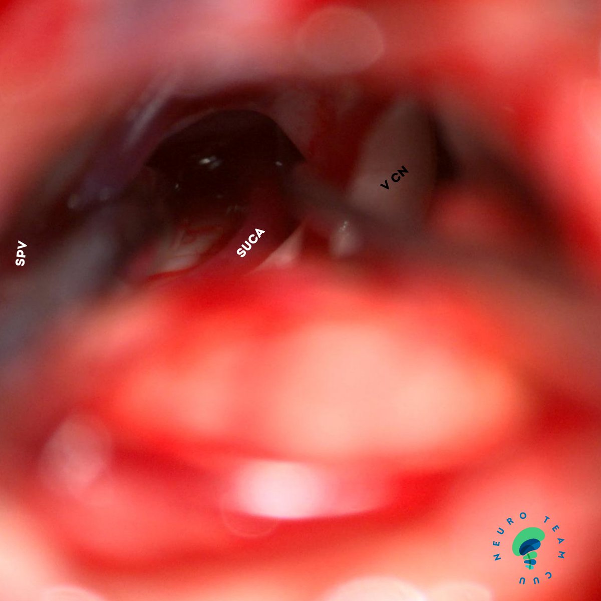 ordomd's tweet image. Microvascular decompression for trigeminal neuralgia through retrosigmoid approach

@DrArturoMCobos @Ostorfi @luisalane9 @Jose_Carlossss 

#trigeminal #neuralgia #pain #facialpain #neuroteamcuu #neurosurgery #microsurgery #medicine