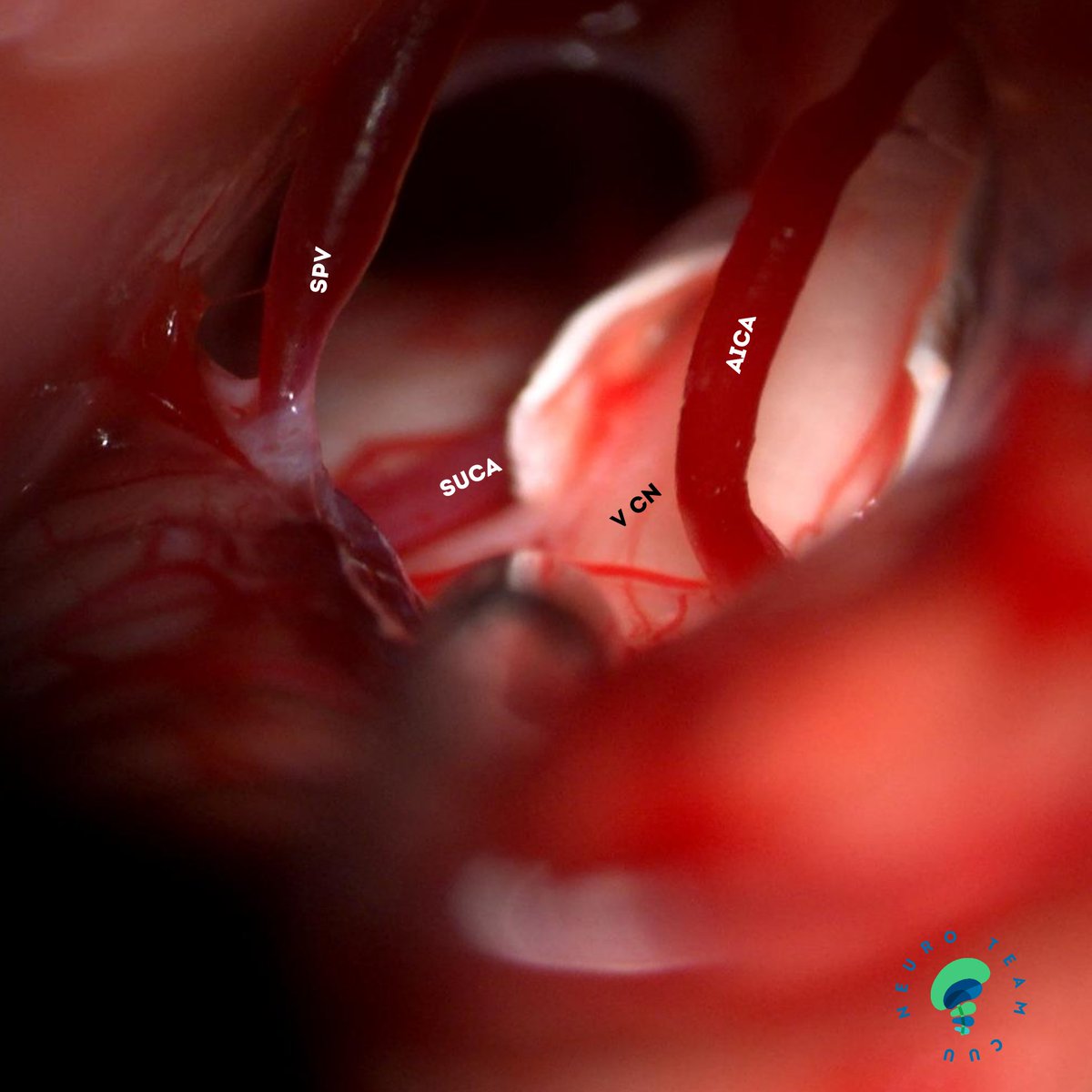 ordomd's tweet image. Microvascular decompression for trigeminal neuralgia through retrosigmoid approach

@DrArturoMCobos @Ostorfi @luisalane9 @Jose_Carlossss 

#trigeminal #neuralgia #pain #facialpain #neuroteamcuu #neurosurgery #microsurgery #medicine