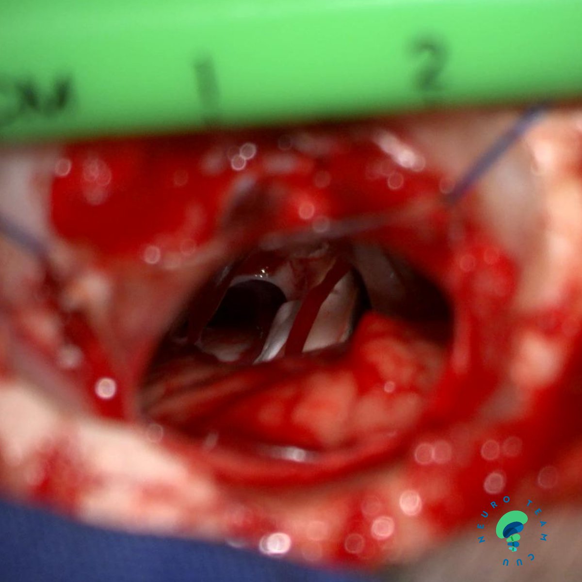 ordomd's tweet image. Microvascular decompression for trigeminal neuralgia through retrosigmoid approach

@DrArturoMCobos @Ostorfi @luisalane9 @Jose_Carlossss 

#trigeminal #neuralgia #pain #facialpain #neuroteamcuu #neurosurgery #microsurgery #medicine