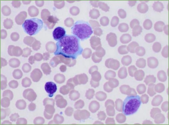 Blood smear with classic reactive lymphocytosis (EBV-driven infectious mononucleosis).

The Downey classification system is useful for recognizing the wide variety of lymphocyte morphologies typical of a reactive lymphocytosis.

Watch my #CAP20virtual course for more!

#hemepath