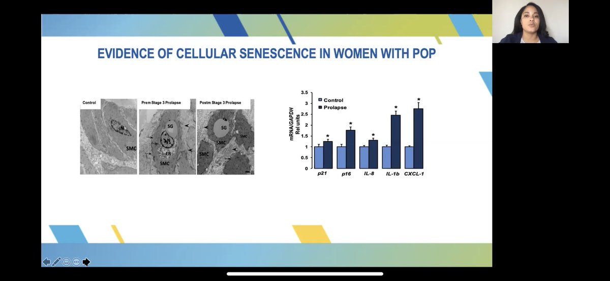 ChristyHicksAPP's tweet photo. Great presentations by Dr Maria Florian-Rodriguez and Dr Adam Hare on cellular senescence and POP! Don’t forget to check these abstracts out if you missed them! @FPMRS @mflorianmd @AMHare #pfdweek20 https://t.co/7tA6HxRWLh