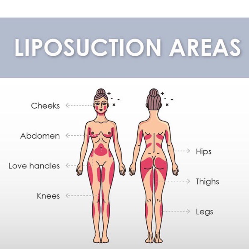 Liposuction can be performed on multiple areas to help you achieve the physique you desire. Liposuction is designed to enhance definition and slim trouble areas. Common areas of correction include:⁣⁣Ab’s⁣, Hips⁣, Thighs⁣, Back⁣, Arms⁣, Neck⁣ & Knees⁣