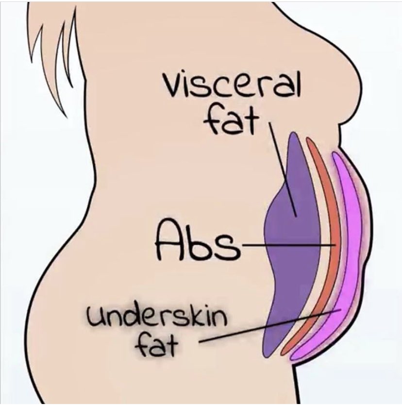 Also, liposuction can only remove the fat directly below skin(external fat) . Depending on how overweight you are, there’s a strong chance you have fat around your organs( internal fat) , below the muscle , which cannot be removed with liposuction.