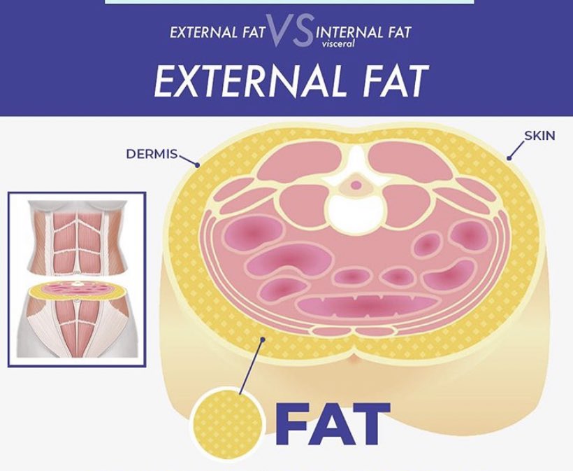 Also, liposuction can only remove the fat directly below skin(external fat) . Depending on how overweight you are, there’s a strong chance you have fat around your organs( internal fat) , below the muscle , which cannot be removed with liposuction.