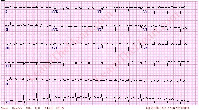 LearntheHeart's tweet image. Atrial Tachycardia with 2:1 block from digoxin toxicity

ECG #Digoxin #toxicology USMLE #Cardiology