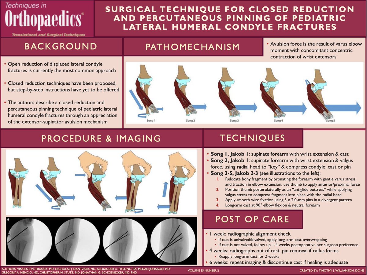 Our latest #VisualAbstract in out! 

"Surgical Technique for Closed Reduction and Percutaneous Pinning of Pediatric Lateral Humeral Condyle Fractures."

#Orthopedics #orthotwitter #orthopaedics