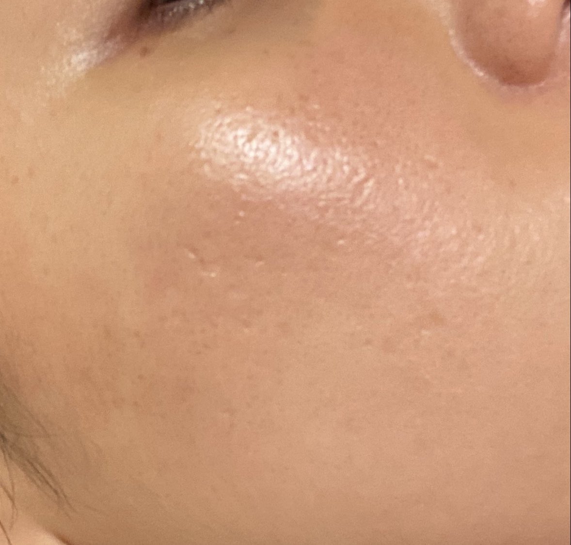 微女 ありがとうございますもう見るに耐えないニキビ肌でした ダーマペン直後アミノ酸化粧水だけだと確かに物足りなさを感じていたので ツイートされてたソフィスタンス アドバンスト使ってみます お互いクレーター撲滅する為に頑張りましょう