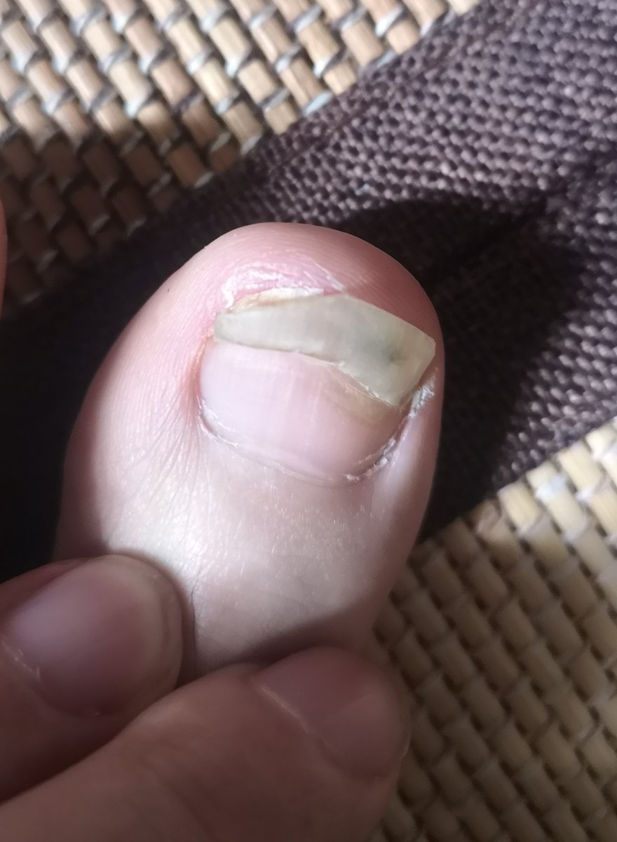 剥がれ 爪 た が 親指 の の 足 爪が剥がれかけた場合の対処法7選