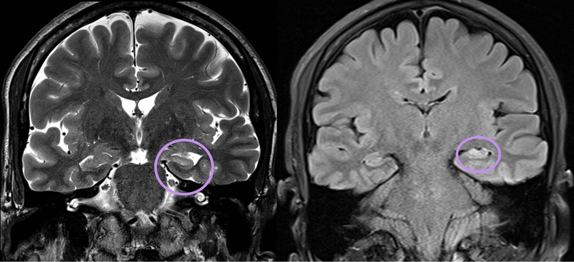 Aaron Rutman, MD on Twitter: "7/8..Note the hippocampus is somewhat