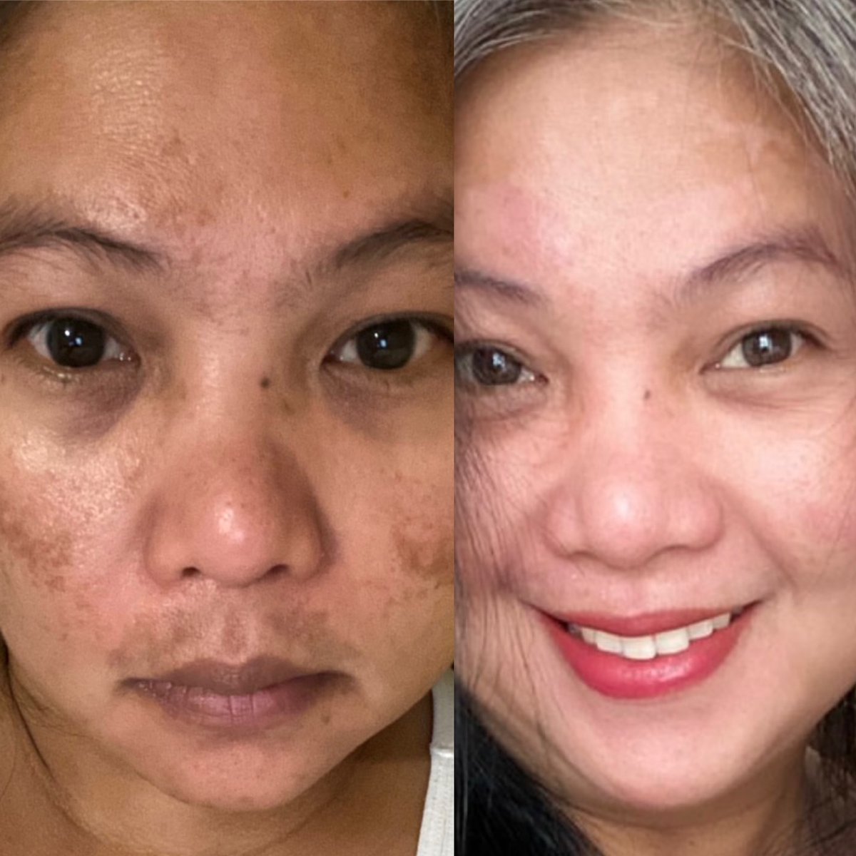 Melasma treatment with Picosure - eepurl.com/hfWHWn