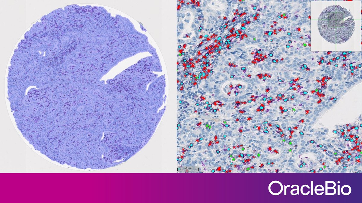 OracleBio's tweet image. OracleBio’s Tissue Microarray Analysis is powerful technique for target validation, patient stratification and biomarker identification. Find out more: ow.ly/VO2y50BQfTX
#digitalpathology #tissuemicroarray #tissueanalysis
