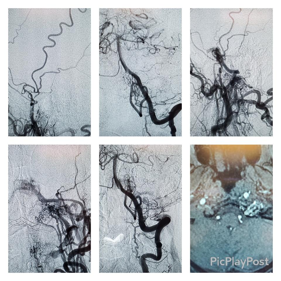 Rare type anterior condylar vein fistula with supply via ascending pharyngeal, occipital, and vertebra arteries. Transvenous embo resulted in angiographic cure and grateful patient with no more pulsatile tinnitus. <a href="/fortesmd/">Dr. Manuel Fortes</a> <a href="/AmeetChitaleMD/">Ameet V Chitale, MD FAANS</a> <a href="/InovaHealth/">Inova</a> <a href="/FairfaxRad/">Fairfax Radiology Centers</a> @NeuroUnited