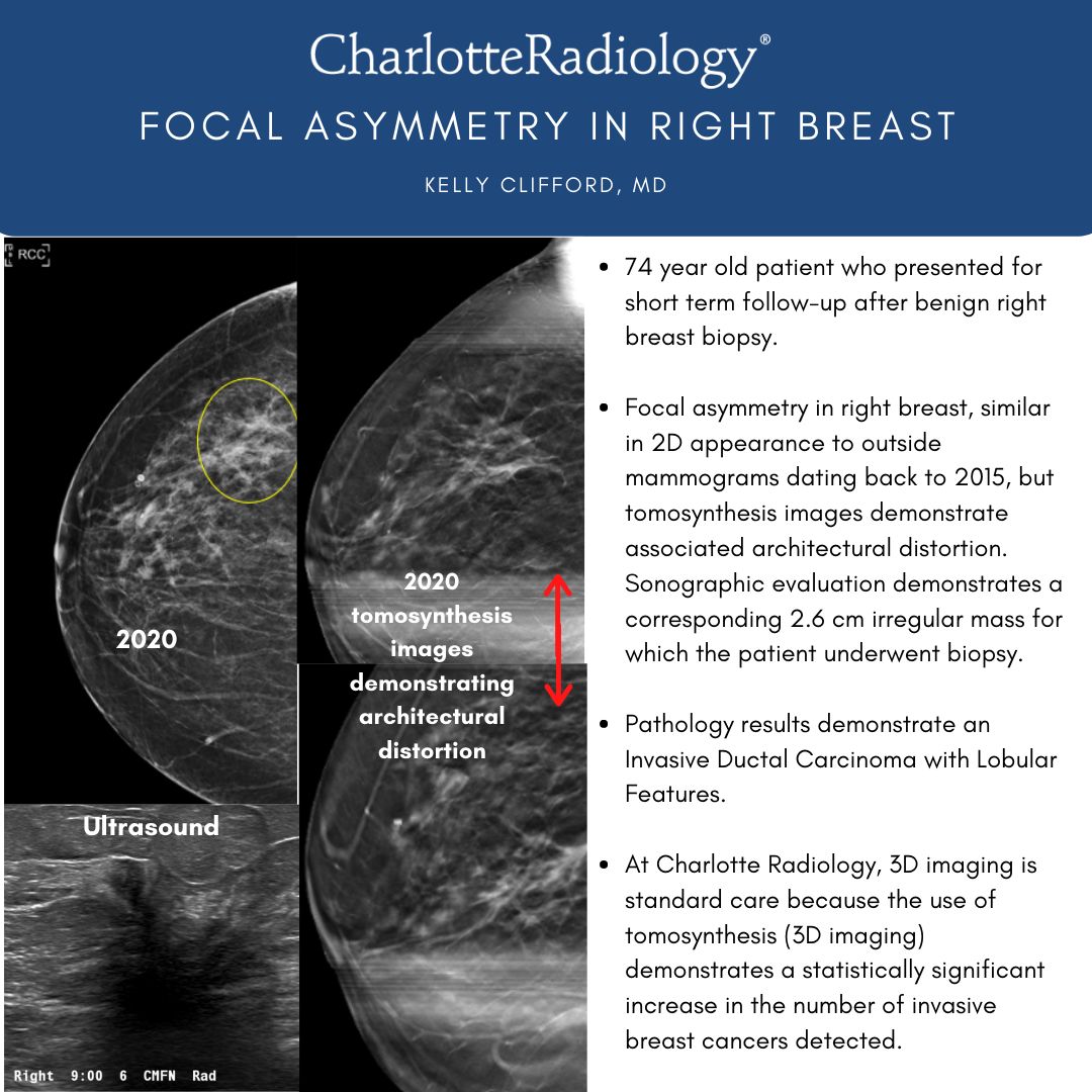 CLTRadiology's tweet photo. At Charlotte Radiology, 3D imaging is standard care because we strive to be at the forefront of technology. This Case Study Tuesday, Kelly Clifford, MD shares how she used 3D imaging to detect an irregular mass in a patient's right breast. #CaseStudyTuesday https://t.co/soHf6oR79y