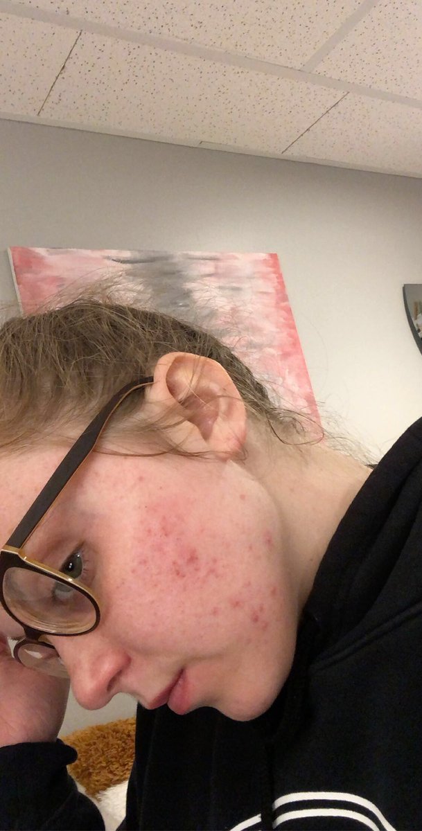 Not many people know how bad I have struggled with my acne and how bad it has affected my self confidence. Although I still have a long way to go, I am so happy to see the progress and I am learning to love my scars :))
