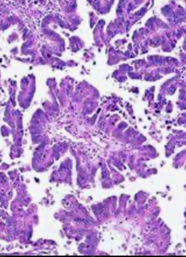 docnax's tweet image. Spotted this wretched tumour in the endometrium of a poor 60 year old lady #pathology #twitterpath #gynaecpathology