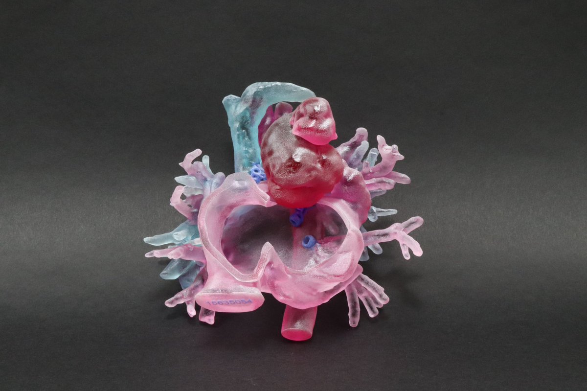 JayMorris_MD's tweet photo. Patients w/ #congenital #heart #disease #CHD live long normal lives but can have 2-3 surgeries into adulthood. Your #surgeon may not be original surgeon . #3Dprinting patient #anatomy &amp; anastamosis aid in surgical planning. #MedTwitter #MedTech @MayoSurgEd @MayoPedsSurgery https://t.co/frx1qwGNSn