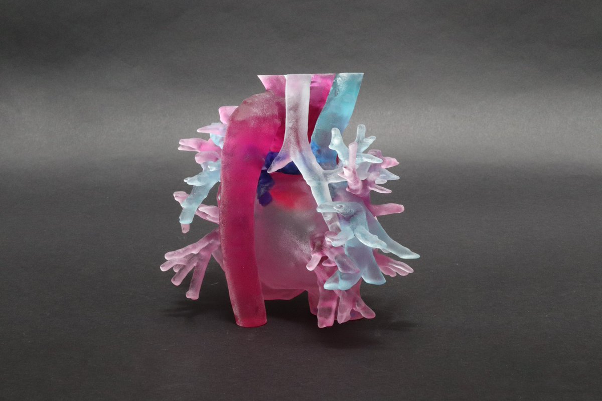 JayMorris_MD's tweet photo. Patients w/ #congenital #heart #disease #CHD live long normal lives but can have 2-3 surgeries into adulthood. Your #surgeon may not be original surgeon . #3Dprinting patient #anatomy &amp; anastamosis aid in surgical planning. #MedTwitter #MedTech @MayoSurgEd @MayoPedsSurgery https://t.co/frx1qwGNSn