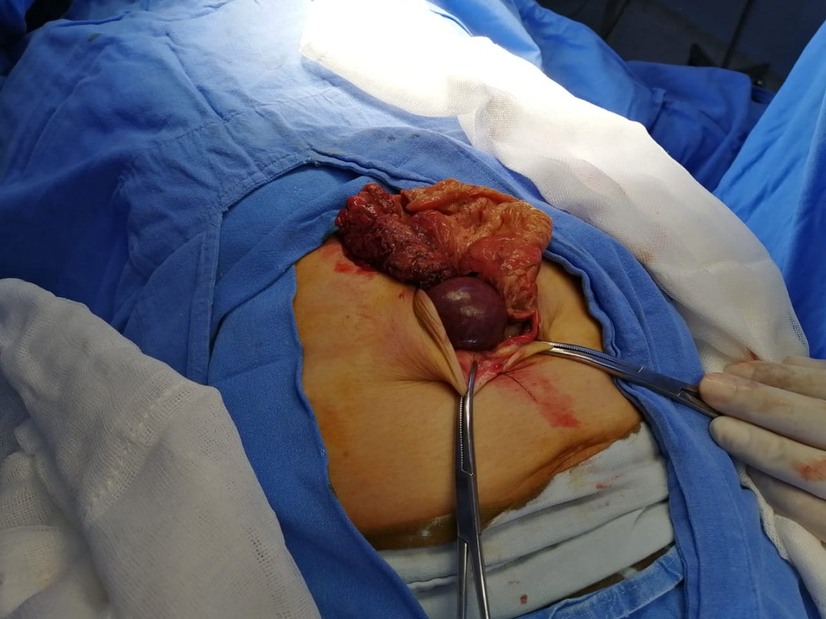 ElCirugia's tweet photo. Pero porque me va a operar Dr. Solo es una hernia!! #herniaestrangulada https://t.co/09NyDi3mn3