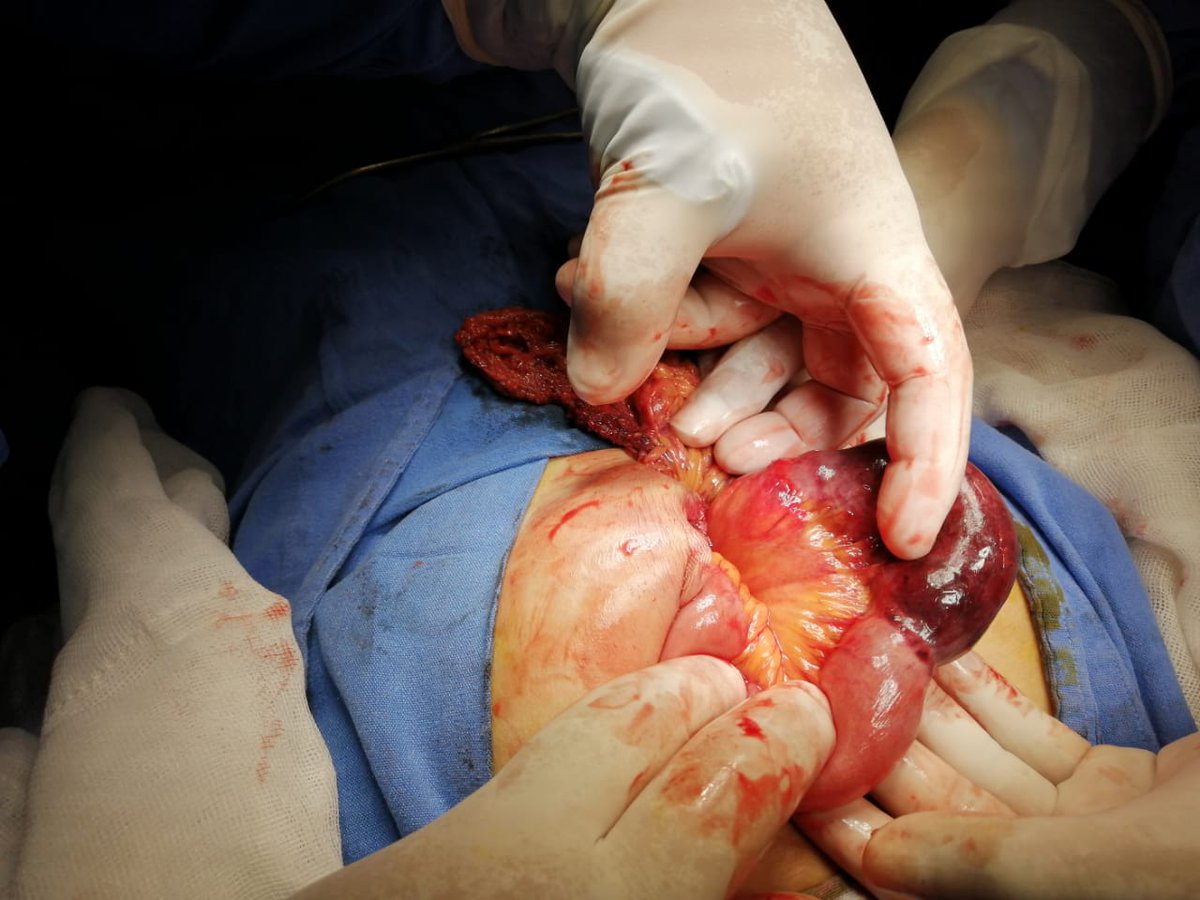 ElCirugia's tweet photo. Pero porque me va a operar Dr. Solo es una hernia!! #herniaestrangulada https://t.co/09NyDi3mn3