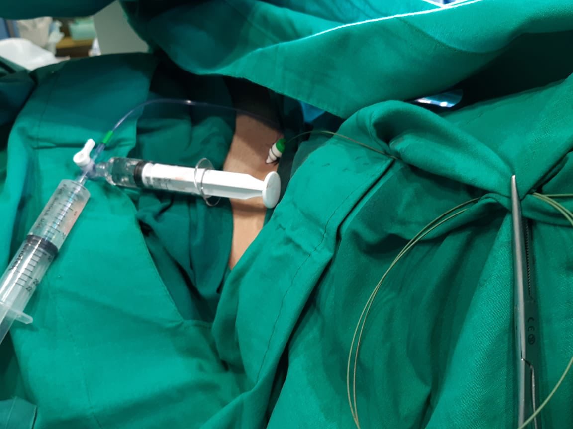 traumasotero's tweet photo. REBOA is a form of early control of non-compressible torso bleeding. Initially our protocol is for highly selected patients. @talherer @Cirbosque @SOCICH_ @NakulRaykar @julianita206 @traumakhan @bryanacotton1 @ordonezcarlosa @EVTMSociety @shocktrauma @ACSTrauma #REBOAUTUsotero https://t.co/jvFoOL3VXf