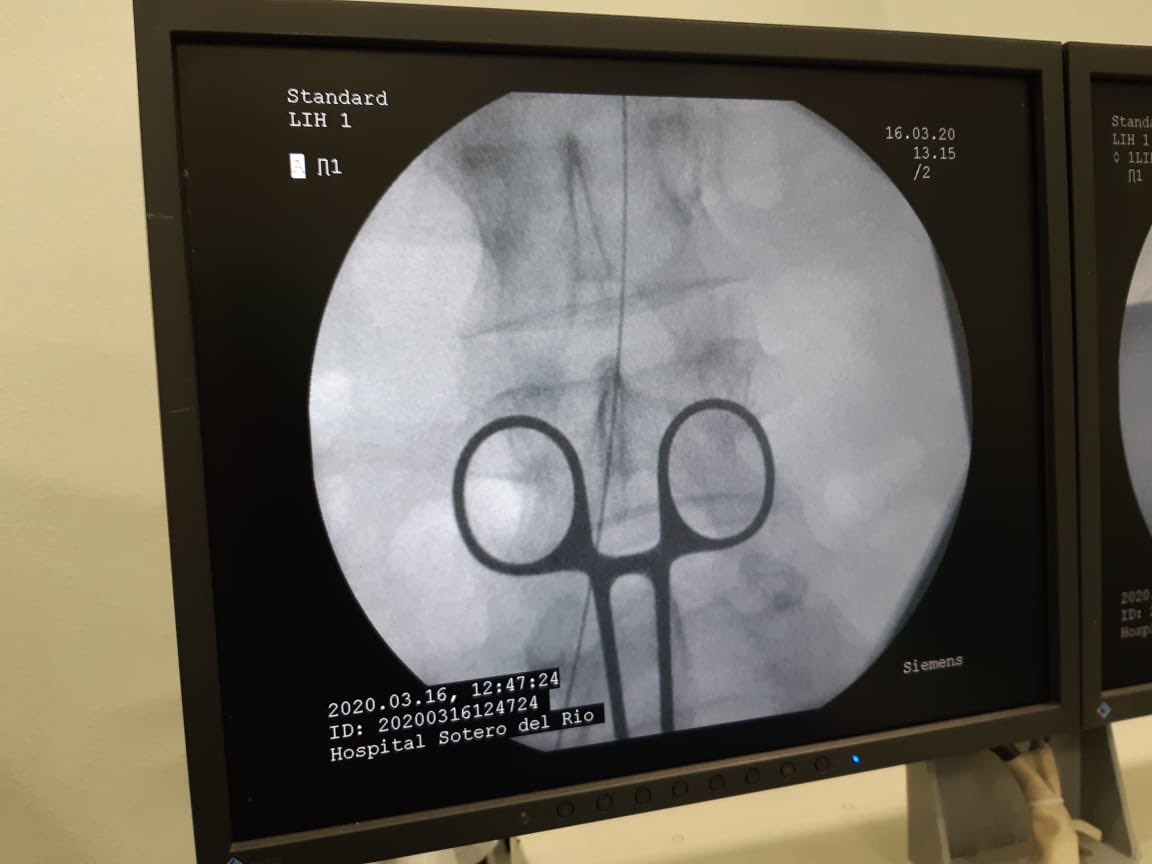 REBOA is a form of early control of non-compressible torso bleeding. Initially our protocol is for highly selected patients. <a href="/talherer/">Tal Hörer</a> @Cirbosque @SOCICH_ <a href="/NakulRaykar/">Nakul Raykar</a> <a href="/julianita206/">Juliana Maria Ordoñez MD FACS MACC MSPT</a> @traumakhan <a href="/bryanacotton1/">Bryan Cotton</a> <a href="/ordonezcarlosa/">Carlos A. Ordoñez</a> <a href="/EVTMSociety/">EndoVascular resuscitation and Trauma Management</a> <a href="/shocktrauma/">Shock Trauma</a> @ACSTrauma #REBOAUTUsotero