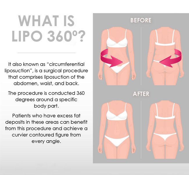 𝙒𝙝𝙖𝙩’𝙨 𝙇𝙞𝙥𝙤 360?Its exactly what It sounds like sounds like. Liposuction done circumferentiallly ( I think thats a real word ) 360 degrees around your body.