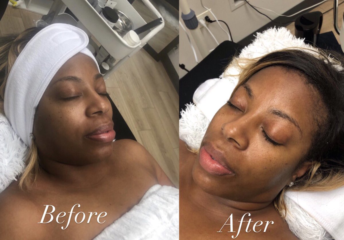 Classic > B r i g t h e n i n g < Facial 💞 will be added to the booking site tonight . skin will 100% glow 🤍