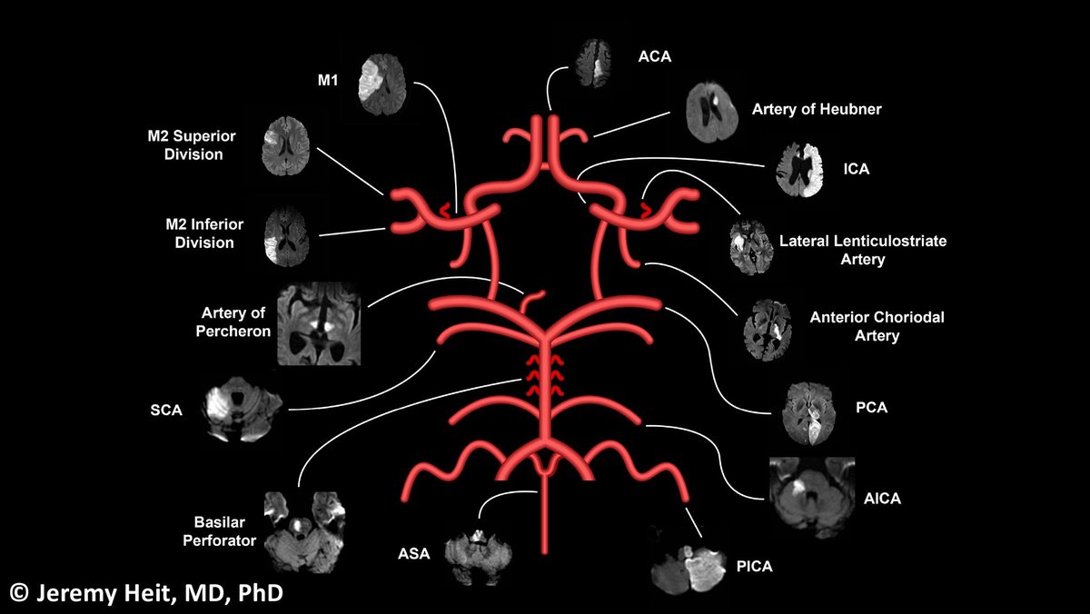 A great reference to keep close-at-hand by <a href="/JeremyHeitMDPHD/">Jeremy Heit, MD, PhD</a>