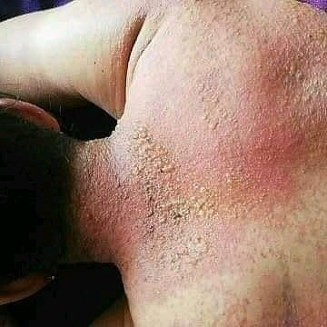 #PacosAsesinos │ Químicos utilizados ayer por el carro lanza aguas contra manifestantes dejo varios heridos por quemaduras a la piel y manifestantes con contusiones tras ser impactados directamente por el chorro del carro. 

NO respetan los protocolos.