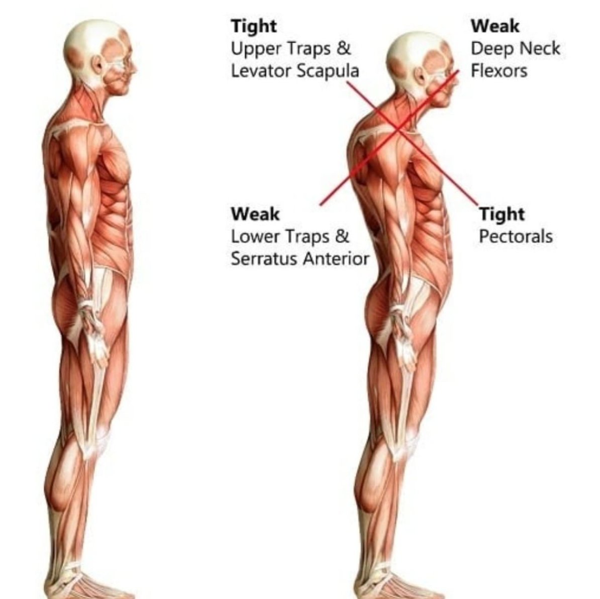 HaloProductsInc's tweet image. Repost from @bwclinic_cf #Uppercrosssyndrome #posturetips