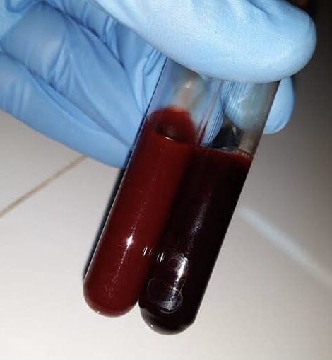 Veamos la importancia del ejercicio:
Observen estás dos muestras de sangre, a la izquierda se observa sangre arterial y a la derecha vemos sangre venosa.
La sangre arterial es rica en oxígeno, mientras que la venosa es la que te entierro.