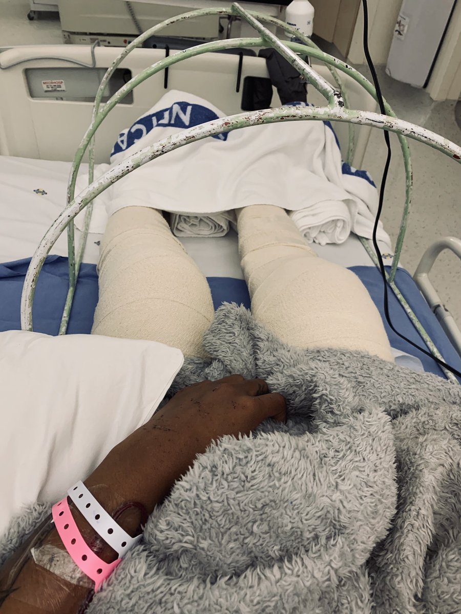 I had broken my left thigh bone into two, both my knees, my left ankle, my left hip and my right destal femur.There was no hope for my legs, I even had a metal thing that protected them while in hospital