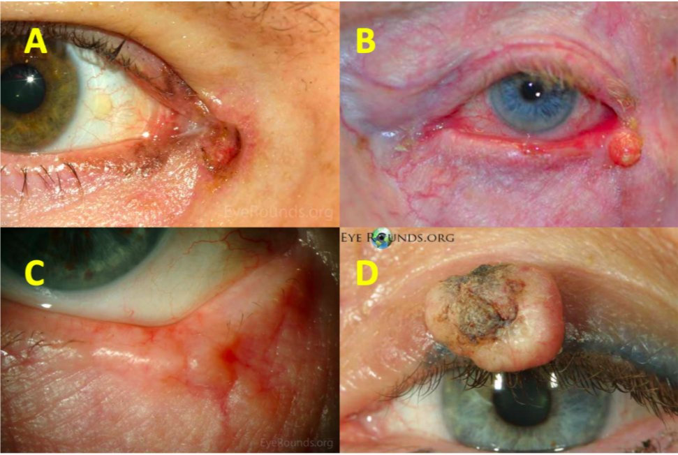 Can you match the eyelid malignancies the the images below? #Ophthalmology #MedTwitter 
1. Keratoacanthoma
2. Squamous Cell
3. Melanoma
4. Basal Cell

Thanks <a href="/EyeRounds/">EyeRounds</a> - as per usual ;) - for all of the wonderful resources! And check out the answers at lensophthalmology.com/question-of-th…