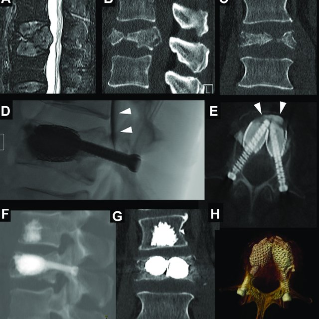 Great debate with a great faculty about SAIF - how to treat the most severe vertebral compression fractures by means of minimally invasive interventional procedure. Don't miss it!
04:00 PM EST (Europe: 21:00 GMT/22:00 CET). <a href="/JoshuaAHirsch/">Josh Hirsch</a> <a href="/ESNRad/">ESNR</a> <a href="/TheASNR/">The American Society of Neuroradiology</a> #NeuroIR #Neurosurgery
