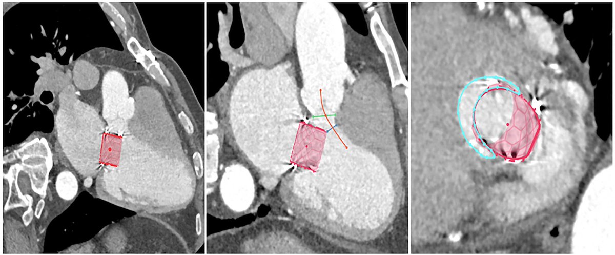 MyJSCAI's tweet photo. For selected patients, #transseptal &amp; #transapical #ViV #TMVr present an alternative to redo‐#SMVR w/ comparable 1‐year survival.

https://t.co/0igOpeUsoK

Follow @CCIJournal, https://t.co/oEQYGHoWy4
Official Journal of @SCAI https://t.co/rpgfJ67Fss