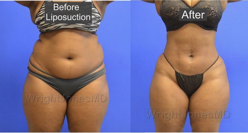 Here’s another example of the magical body transformation powers of Lipo 360. It can truly drastically change your silhouette.