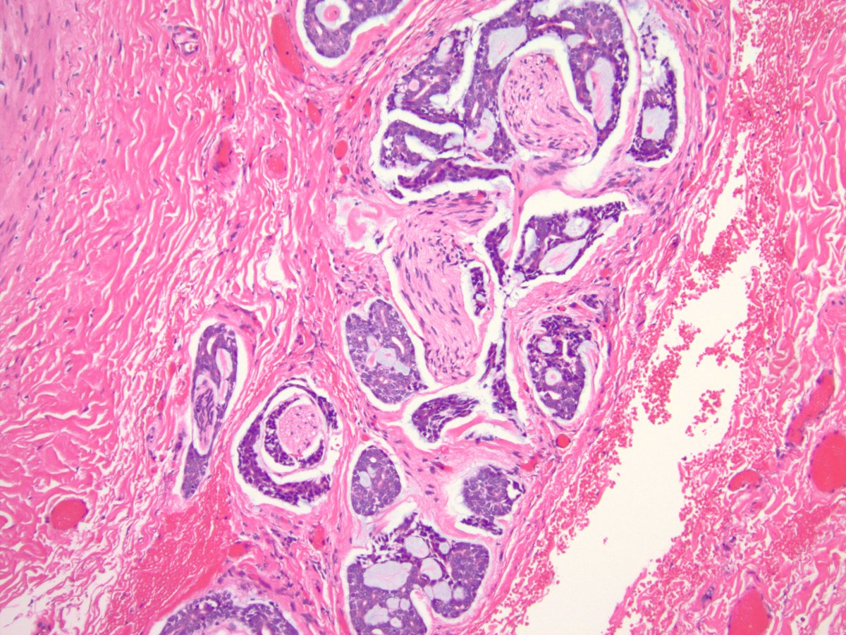 Adenoid cystic carcinoma just loves nerves!

#ENTpath #pathology #medicine #PathTwitter <a href="/smlungpathguy/">Sanjay Mukhopadhyay</a> <a href="/RDWhaleyMD/">Rumeal D. Whaley, MD</a> <a href="/ENT_Path/">Cleveland Clinic Head and Neck Pathology</a>
