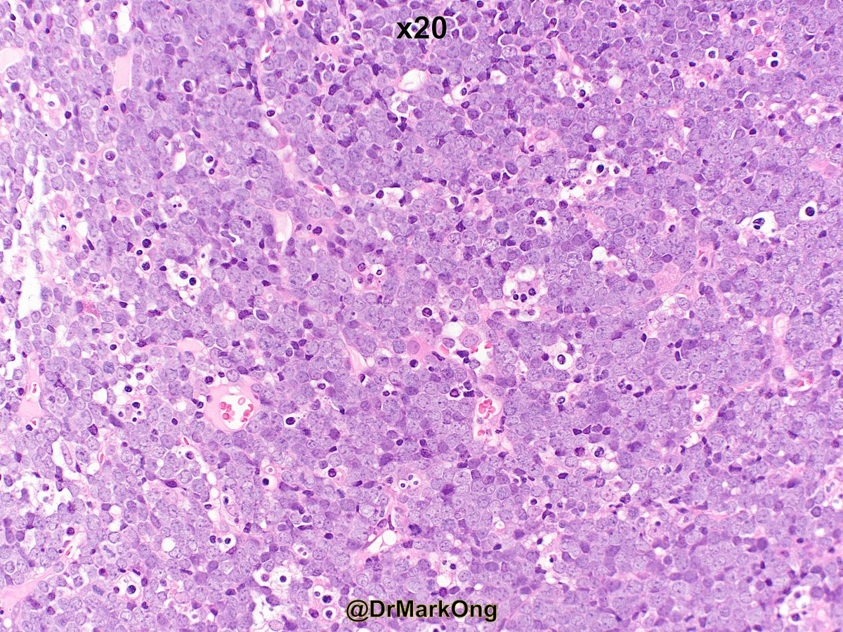 DrMarkOng's tweet photo. Young adult with intra-abdominal mass. Bone marrow trephine biopsy. Starry sky appearance of Burkitt's lymphoma #hemepath https://t.co/6a5iHukibk