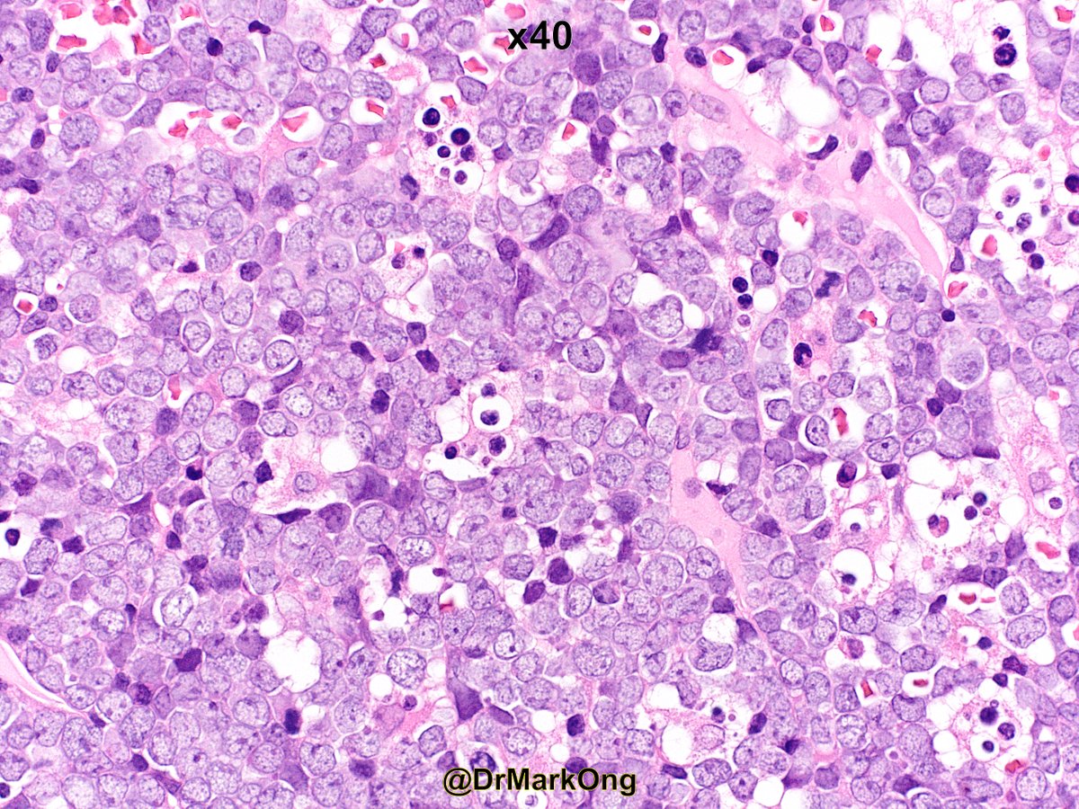 DrMarkOng's tweet photo. Young adult with intra-abdominal mass. Bone marrow trephine biopsy. Starry sky appearance of Burkitt's lymphoma #hemepath https://t.co/6a5iHukibk