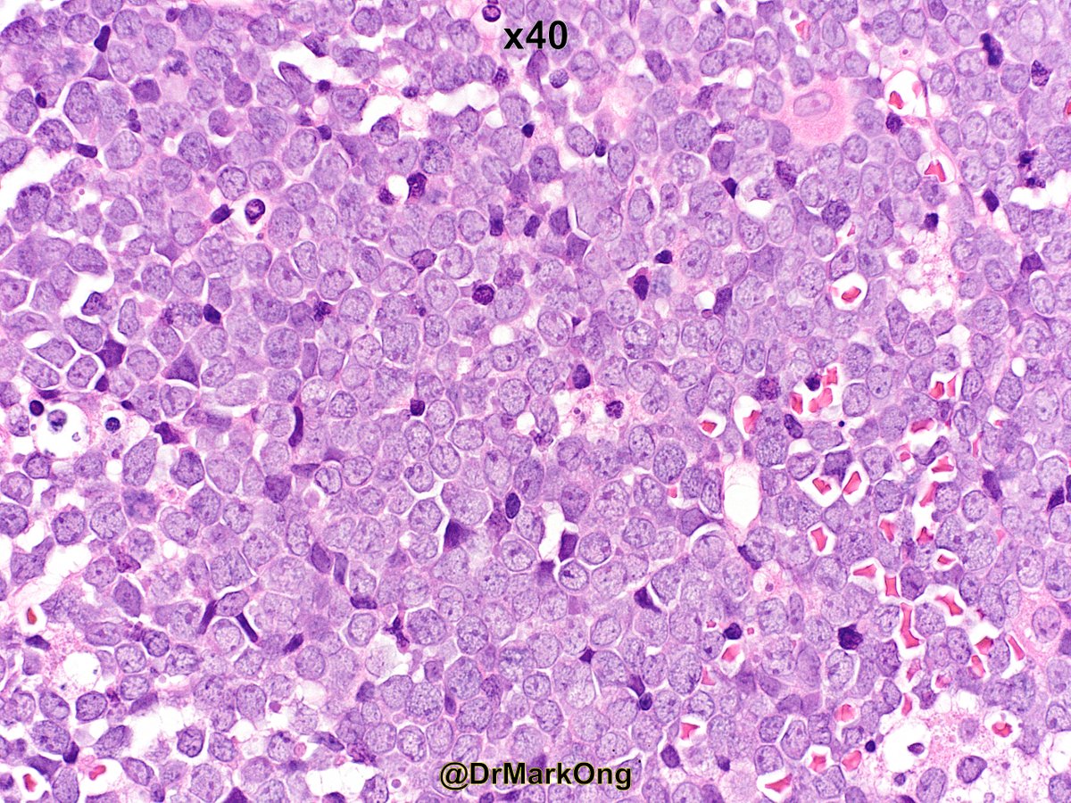 DrMarkOng's tweet photo. Young adult with intra-abdominal mass. Bone marrow trephine biopsy. Starry sky appearance of Burkitt's lymphoma #hemepath https://t.co/6a5iHukibk