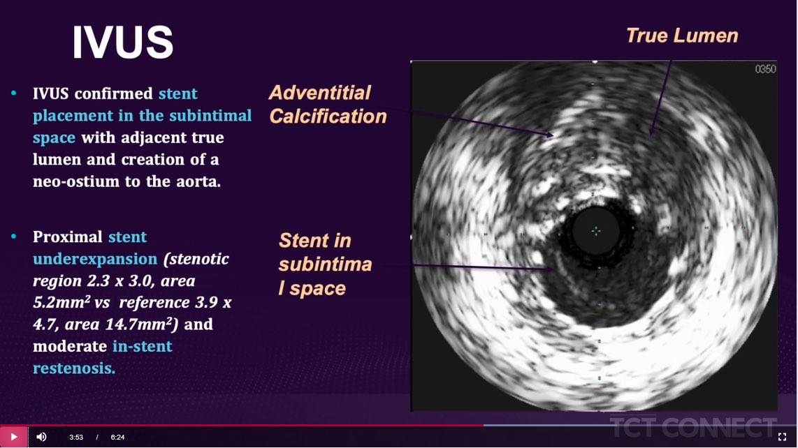 OHSU Cardiology Fellowship (@ohsucardfellows) on Twitter photo Congrats to our fellows on their strong work at #TCTConnect: 2 of the 15 top-graded challenging cases are by @OHSUCardFellow, PGY5 <a href="/TimSimpsonMD/">Tim Simpson</a> and structural fellow Josh Vogt, with the mentorship of <a href="/PunagD/">Punag Divanji</a> & <a href="/HarshGMD/">Harsh Golwala</a>. See <a href="/TimSimpsonMD/">Tim Simpson</a>’s case below— Congrats to our fellows on their strong work at #TCTConnect: 2 of the 15 top-graded challenging cases are by @OHSUCardFellow, PGY5 <a href="/TimSimpsonMD/">Tim Simpson</a> and structural fellow Josh Vogt, with the mentorship of <a href="/PunagD/">Punag Divanji</a> & <a href="/HarshGMD/">Harsh Golwala</a>. See <a href="/TimSimpsonMD/">Tim Simpson</a>’s case below—