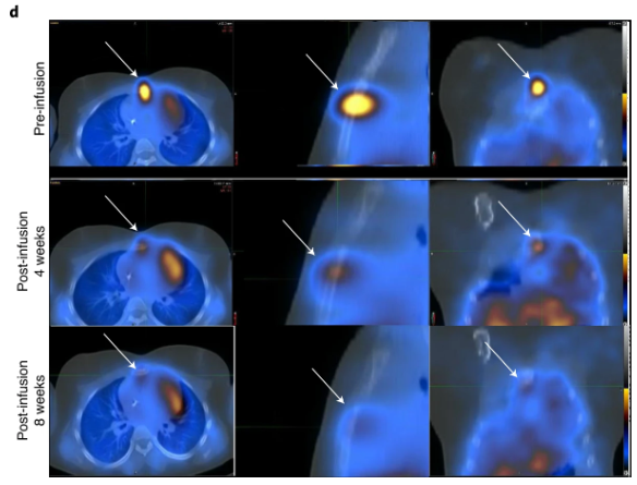 In an interim analysis of a first-in-human phase 1 #clinicaltrial in patients with #neuroblastoma, highly pure GD2-specific CAR natural killer T cells were well-tolerated with no observed dose-limiting toxicities nature.com/articles/s4159… #NMEDclinical #Immunotherapy #Immunology