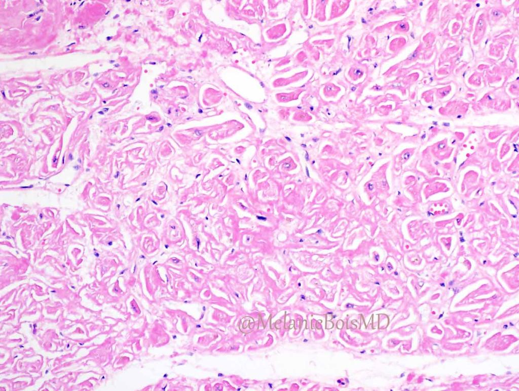 MayoClinicPath's tweet photo. 1/13
Here comes the answer to the previous #HEARTThursday question!  Get ready for an excellent discussion with @MelanieBoisMD!  #CPpath #APpath #CardiacPath @joemaleszewski @aubry_mc https://t.co/unLyRAyAAj