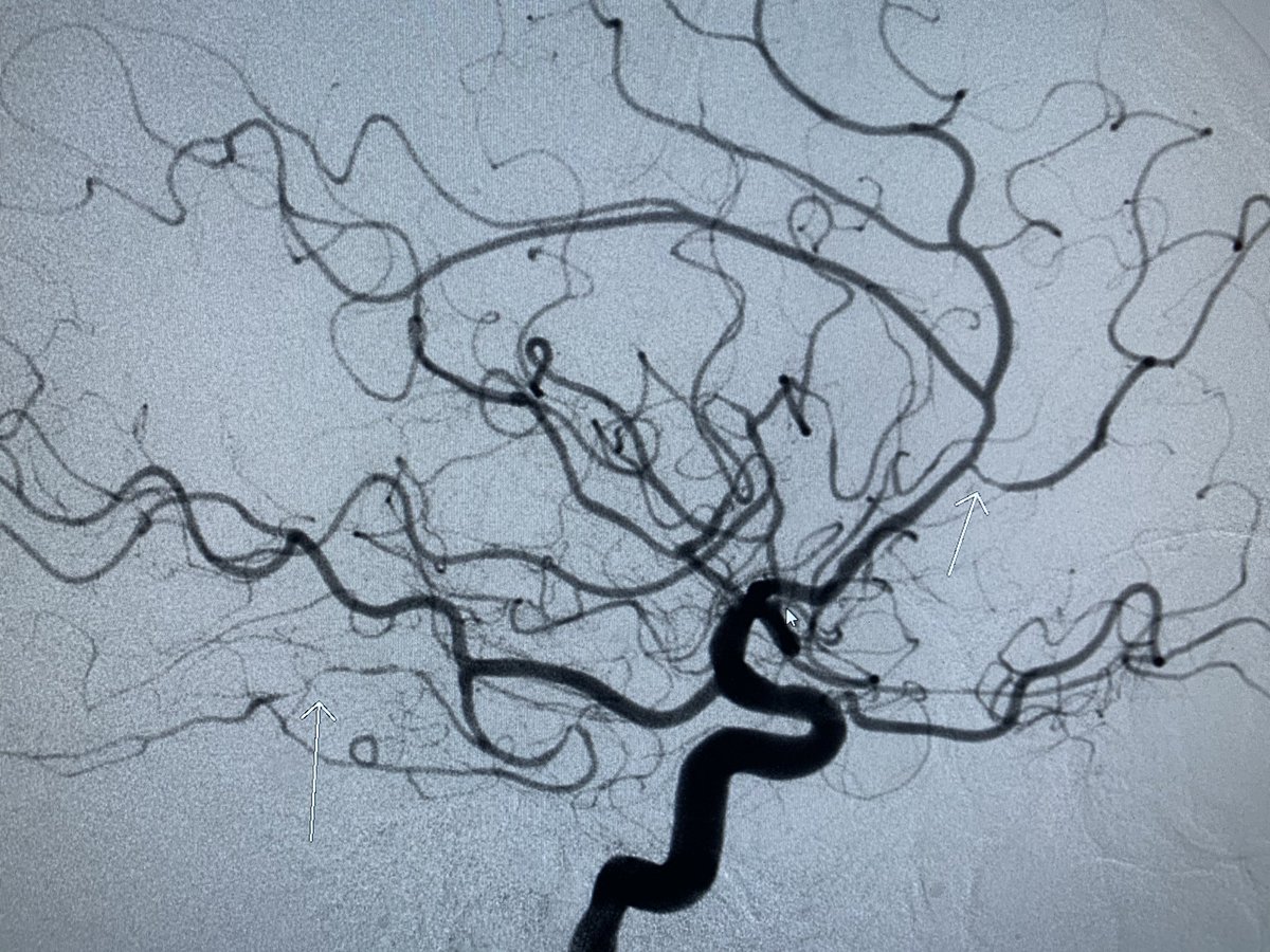 Fantastic and not a subtle example of cerebral vasculitis. #FOAMrad