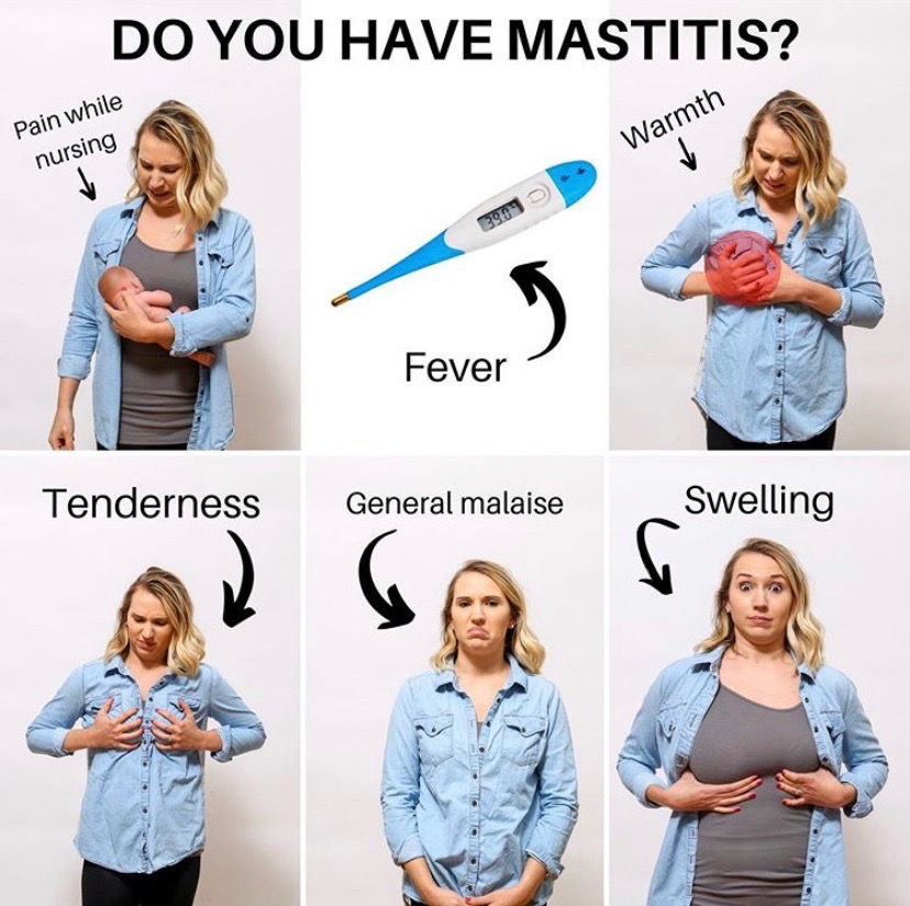 Mastitis! 😫⁣
⠀⠀⁣
❓First of all, what is it?⁣
⠀⠀⁣
From kellymom.com :⁣
⠀⠀⁣
Mastitis is an inflammation of the breast that can be caused by obstruction, infection and/or allergy.

For more, visit instagram.com/p/CGVhIdbg_TH/
